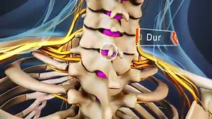9.2K views · 343 reactions | An epidural steroid injection is just...