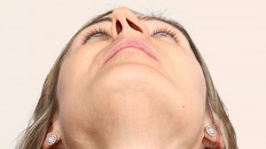 Deviated Nasal Septum: Expert Explains Its Symptoms, Causes, And Treatment Measures