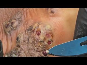 Kelvin Deye's dejiggering - see long video @ riseupsociety.net & ruskenya.org