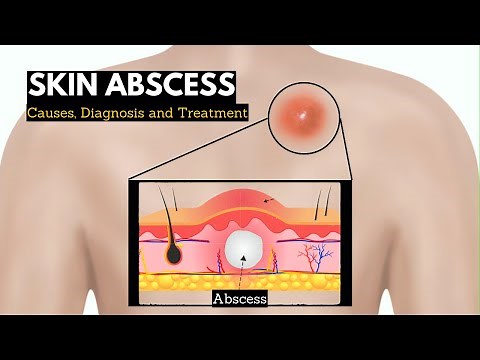 How to Get Rid of an Abscess
