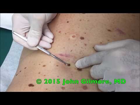 Multiple Dilated Pores - Blackhead Extractor