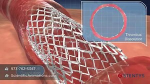 3D Animation of Coronary Stent Procedure...