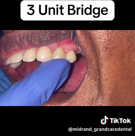 Understanding 3 Unit Dental Bridges Explained