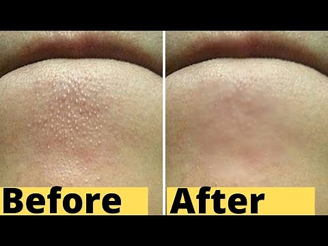 How To Remove Whiteheads And Blackheads From Chin At Home