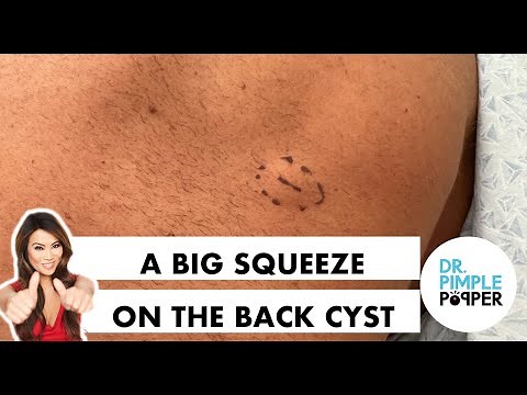 A Big Squeeze Cyst