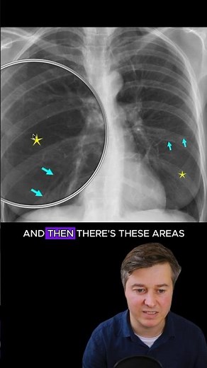 Emphysema on chest x-ray