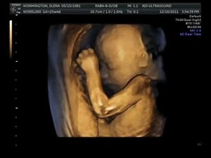 3D ultrasound 25 weeks, 4D view of baby, 25 week pregnancy, baby girl, first view