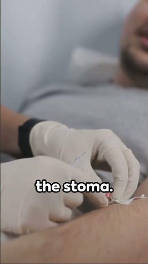 Mastering Suprapubic Catheter Replacement: Simplified and Confident