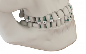 Summit Medical, Inc. Announces Launch of FDA Cleared Jaw Fracture Device Minne Ties® Agile MMF