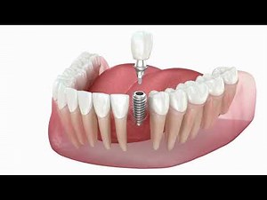 Dental Implant Animation Video | Turkish Dental Implants