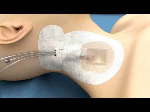 Application & Removal -- 3M™ PICC / CVC Securement Device + Tegaderm™ CHG Dressing