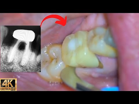 Surgical Tooth Extraction w/ Microscope (LIVE)