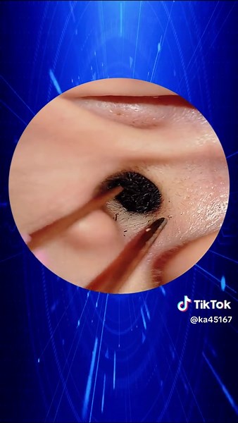 Effective Ear Wax Removal Techniques and Tips