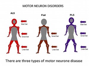 Motor Neuron Disease (MND): 7 Types, Oorzaken, Symptomen & Behandeling - Hersenen - Zenuwstelsel 2025