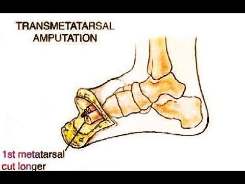 Transmetatarsal Amputation