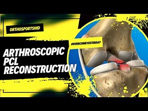 Posterior Cruciate Ligament Reconstruction- A step by step approach