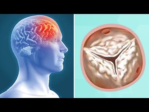 Heart Valve Calcification & Stroke Risk: What Should Patients Know?