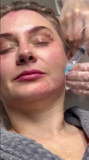 Mesotherapy injection treatments - rejuvenate and revitalize the skin