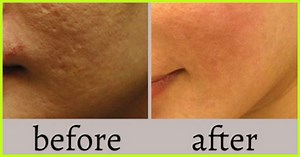 11 Effective Homemade Face Packs To Treat Open Pores