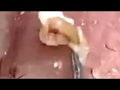 Deep blackhead extraction Cystic acne & pimple popping #35