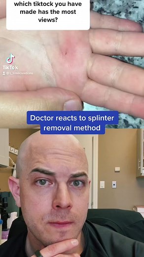 Doctor Demonstrates Effective Splinter Removal Method