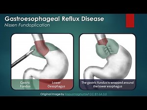 Gastroesophageal Reflux Disease (GERD): Nissen Fundoplication