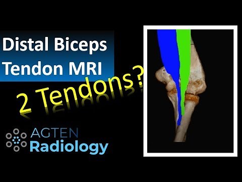Distal Biceps Tendon Rupture on MRI