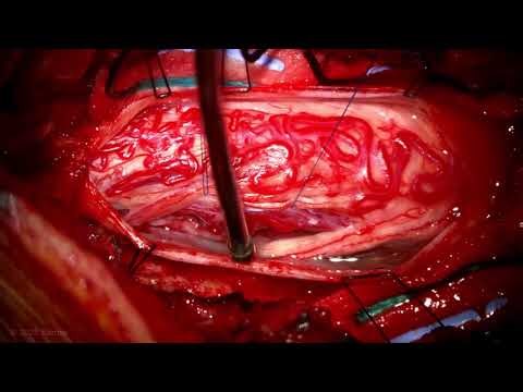 Microsurgical Resection of a Cervical Intramedullary Spinal Cord Arteriovenous Malformation