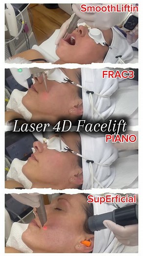 15 reactions · 4 comments | LASER FACELIFT : the future of skin...