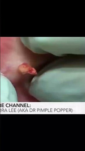 Unplugged... #drpimplepopper #popaholics #oddlysatisfying
