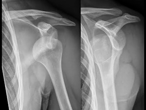 Shoulder Dislocation -Reduction
