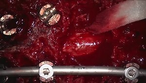 Thoracic Pedicle Subtraction Osteotomy for Fixed Sagittal Deformity