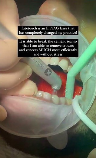 How do you remove 8 emax crowns in under 10 minutes? Without any burs