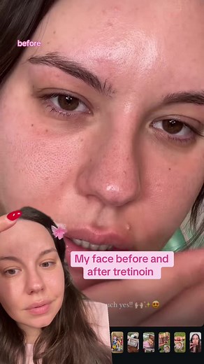Transform Your Skin: Tretinoin Before and After Results