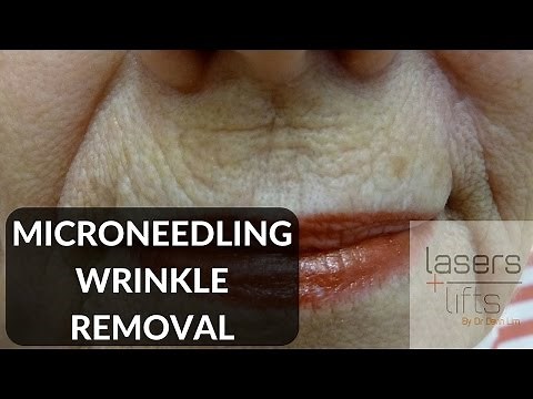 Microneedling for skin rejuvenation