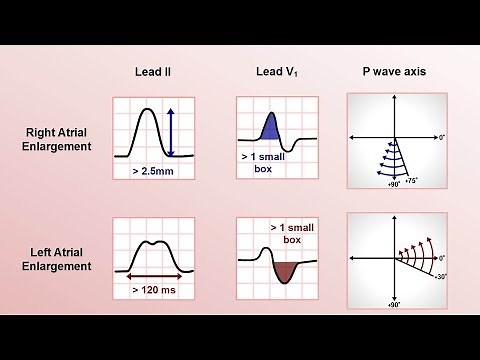 Intro to EKG Interpretation - Chamber Enlargement
