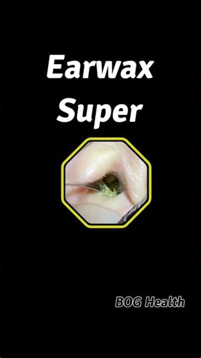 The Truth About Earwax Build Up