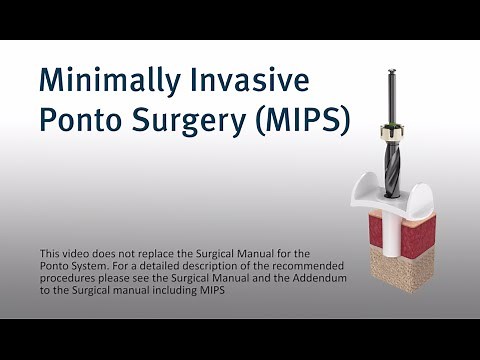 MIPS – Minimally invasive Ponto surgery