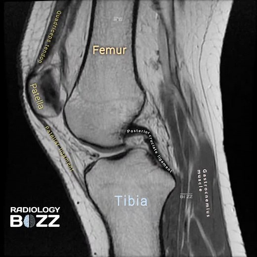 🩻 MRI Knee — Sagittal View Anatomy Highlight! ✨ A beautifully captured Proton Density (PD) sagittal MRI section of the knee joint, perfectly demonstrating key anatomical structures essential for joint stability and movement. 📚 Sequence: PD-weighted — ideal for visualizing soft tissue contrast, ligament integrity, and joint anatomy in exquisite detail. ✨ A perfect image for understanding knee biomechanics and ligament orientation — a must-know for every radiology learner! #RadiologyBuzz #KneeMR