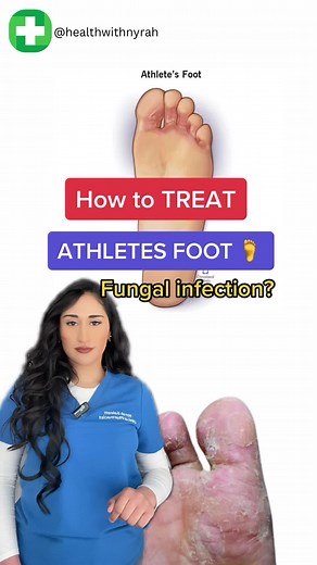 Effective Ways to Treat Athlete's Foot: A Comprehensive Guide