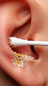 Disgusting Ear Wax & Flakes… GONE in 15 Seconds! 😳👂✨