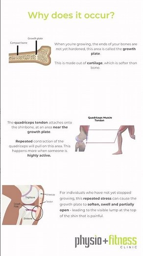 Osgood-Schlatter disease: Causes, Symptoms & Treatments #osgoodschlatter #osgoodschlatterymptoms