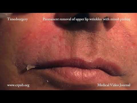 21. Removal of upper lip wrinkles