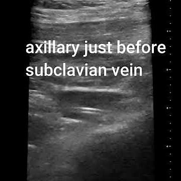 Midclavicular PICC line advancement: Troubleshooting