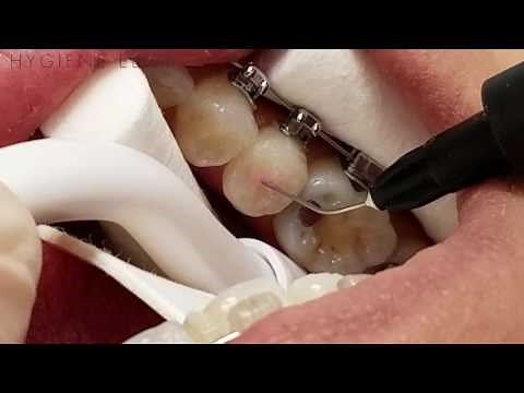 Sealant Placement Procedure