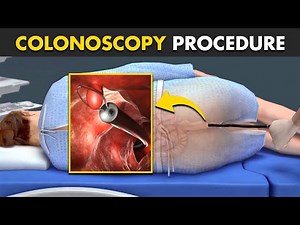 How Colonoscopy Procedure Is Performed? (3D Animation)