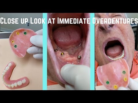Close up look at upper and lower immediate snap-in overdentures