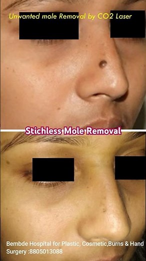 Stichless & Scarless Mole Removal Using CO2 Laser having Best Cosmetic Results with Painless Method