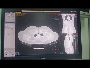 Filming d'un scanner thoraco-abdomino-pelvien(TAP)