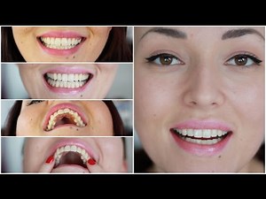 Mijn Invisalign beugel ervaring deel 2 (before en after) | Beautygloss